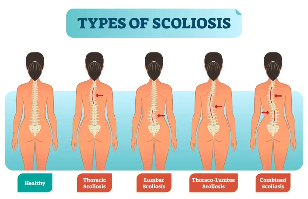 Types Of Scoliosis